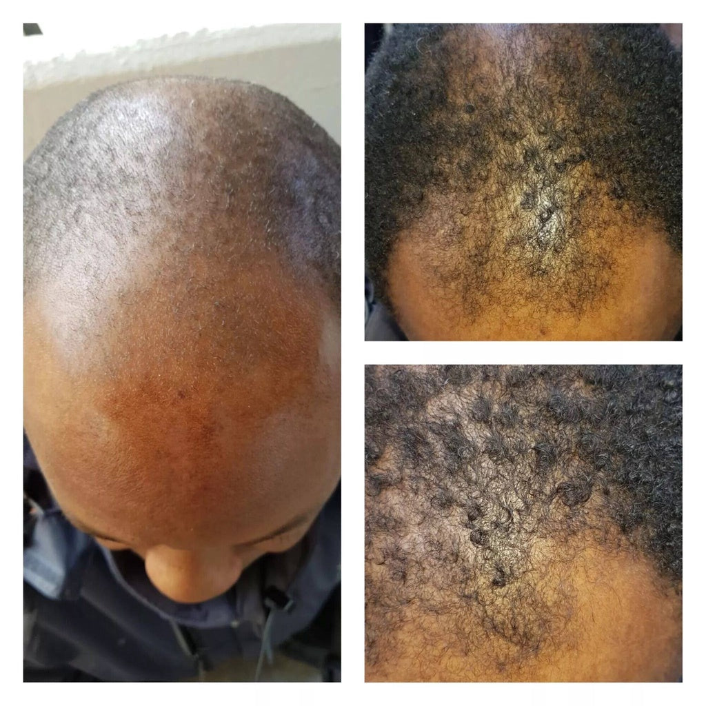 NEO Hair Lotion Spray Hair Loss Treatment