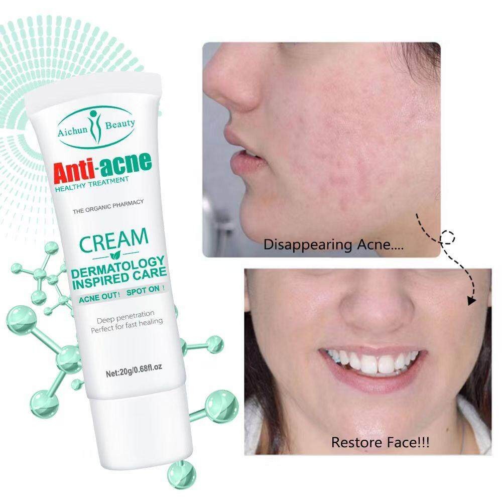 Aichun Anti-Acne Pimple Removal Cream