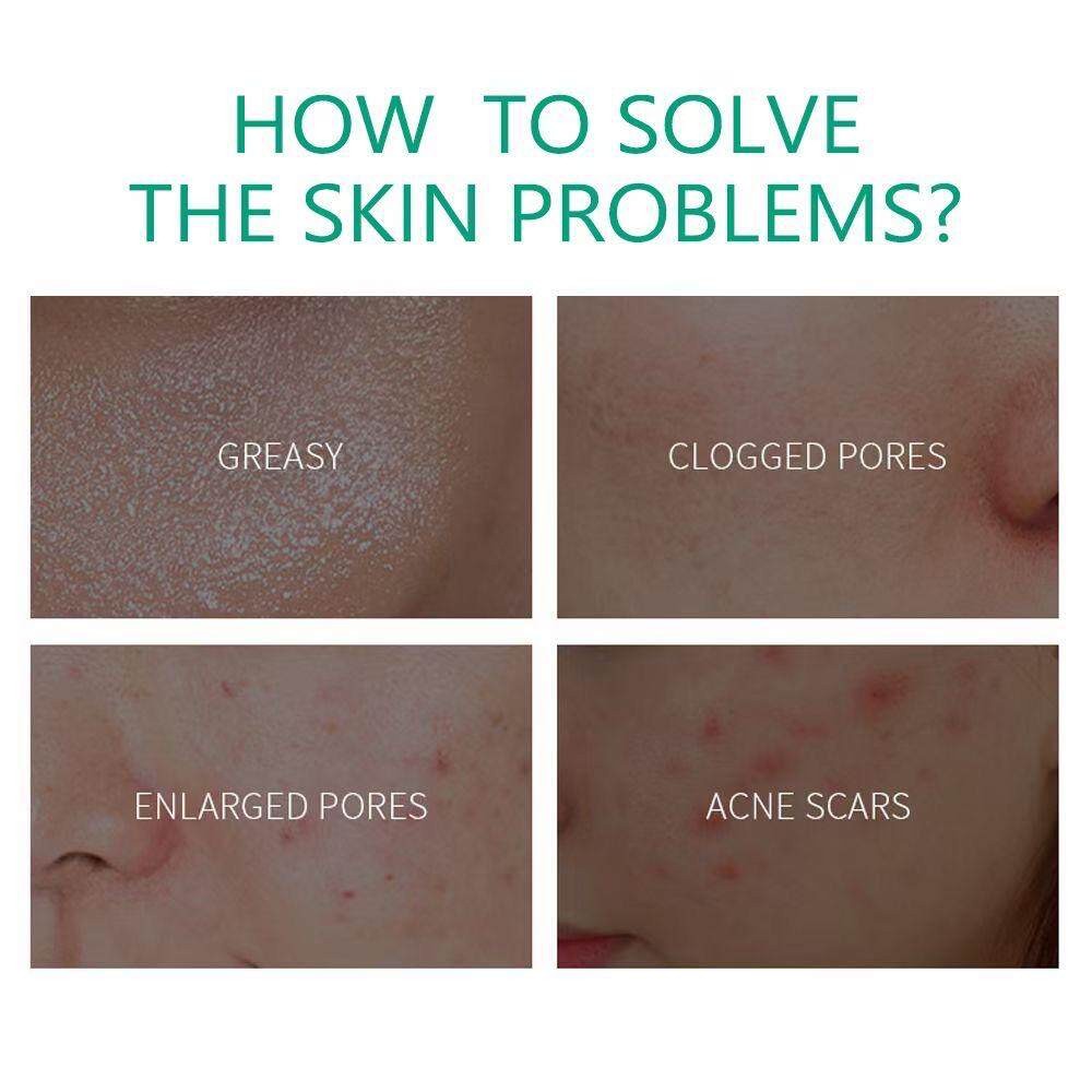 Aichun Anti-Acne Pimple Removal Cream